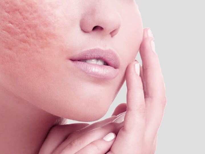 If you want to get rid of the problem of open pores then adopt these domestic methods ओपन पोर्स की समस्या से पाना चाहते हैं निजात तो अपनाएं ये घरेलू तरीके, फॉलो करें इन स्टेप्स को