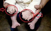  এই শিশুর হাতে-পায়ে আঙুলের সংখ্যা ৩১!