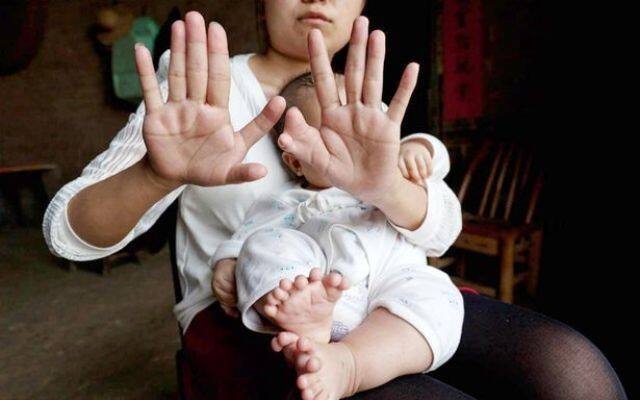 তিনমাসের ওই শিশুর হাতে কোনও বৃদ্ধাঙ্গুলি নেই। রয়েছে দুটি তালু।