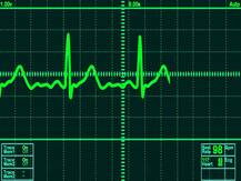 ১৮ ঘন্টা হৃদযন্ত্র বন্ধ থাকার পরও আশ্চর্যভাবে প্রাণ ফিরে পেলেন ৫৩ বছরের ব্যক্তি