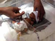 জন্মের সময় ওজন ছিল ৬৫০ গ্রাম, একটি মোবাইলের সমান, চিকিত্সকদের চেষ্টায় এখন শিশুটি সুস্থ