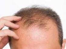 হেয়ার ট্রান্সপ্ল্যান্টের জের, মারা গেলেন মেডিক্যাল পড়ুয়া