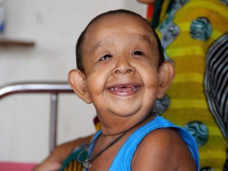 এই শিশুর বয়স ৪, বিরল রোগে আক্রান্ত, দেখতে বৃদ্ধের মতো