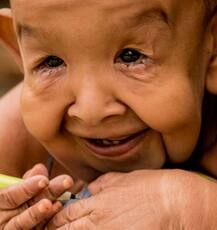 এই শিশুর বয়স ৪, বিরল রোগে আক্রান্ত, দেখতে বৃদ্ধের মতো