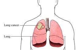 Lung Cancer : फुफ्फुसाचा कर्करोग : लक्षणे, निदान आणि उपचार; जाणून घ्या सर्वकाही