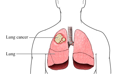 Health News Symptoms Stages Diagnosis and Treatment of Lung Cancer you all need to know Lung Cancer : फुफ्फुसाचा कर्करोग : लक्षणे, निदान आणि उपचार; जाणून घ्या सर्वकाही