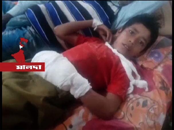 Bomb Blast At Malda A Boy Gets Injured Lost His Left Hands Finger মালদায় বোমা বিস্ফোরণে উড়ে গেল ছাত্রের বাঁ হাতের আঙুল