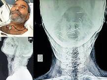 রাজস্থানে এক ব্যক্তির দেহে ঢুকে আছে ৭৫টি পিন, কীভাবে বের করবেন? ধন্দে চিকিত্সকরা