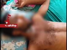 তরুণকে বাড়িতে ডেকে গায়ে অ্যাসিড, পলাতক প্রেমিকার বাবা