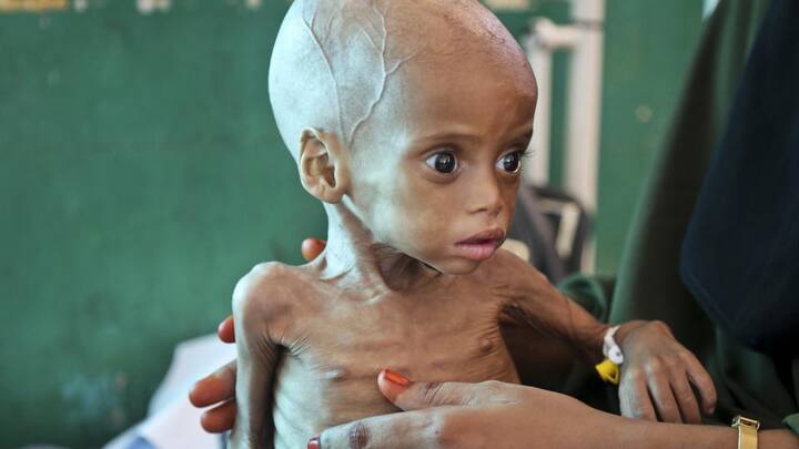 এই শিশুটির বয়স ৯ মাস। সে অপুষ্টির শিকার। একটি হাসপাতালে তার চিকিৎসা চলছে। ছবি সৌজন্যে এপি