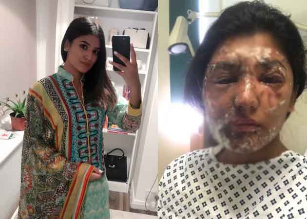 ব্রিটেনবাসী অ্যাসিড আক্রান্ত এই তরুণী টুইটারে শেয়ার করলেন তাঁর সেরে ওঠার ছবি, পড়ুন