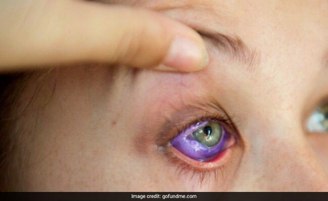 A model tattooed her eyeball purple; she now could lose her eye অক্ষিগোলক বেগুনি রঙে রাঙিয়েছেন এই মডেল, ফলে খোয়াতে পারেন দৃষ্টি