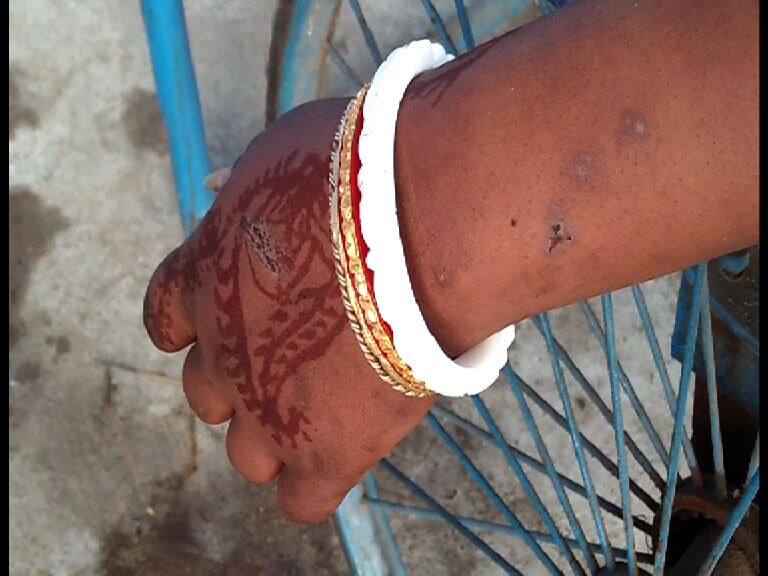 Dark complexion, that’s why newly married girl killed by choking গায়ের রং কালো, বিয়ের চার মাসের মধ্যে নাবালিকা গৃহবধূকে 'শ্বাসরোধ করে খুন', আটক স্বামী