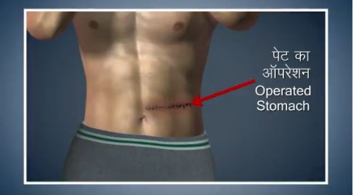 যাঁদের পেটের অস্ত্রোপচার হয়েছে, তাঁদের এই আসন করা উচিত নয়।