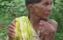 হাতে ১২, পায়ে ২০ আঙুল! প্রতি পাঁচ হাজারে এক, দু জনেরই এমন শারীরিক অসঙ্গতি হয়