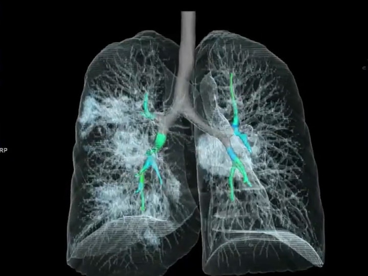 First 3d picture of lung of coronavirus patient সামনে এল করোনা আক্রান্তের ফুসফুসের ৩ ডি ছবি