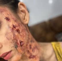 ছিন্ন-ভিন্ন পোশাক, মুখ-হাত পুড়ে দগদগে! সোশ্যাল মিডিয়ায় ছবি শেয়ার করলেন মিমি