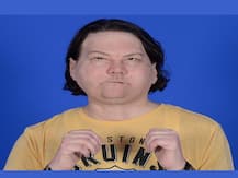 Joe Dimeo transplant: থ্রিডি প্রিন্টেড কাটিং গাইডসের যাদু, হাত মুখ ফিরে পেলেন অগ্নিদগ্ধ যুবক