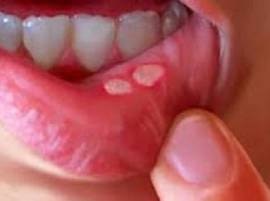 Home Remedies To Cure Mouth Blisters तोंडातील फोड घालवण्यासाठी पाच घरगुती उपाय