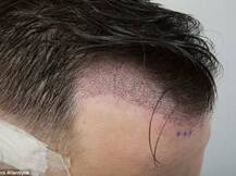 हेअर ट्रान्सप्लांटनंतर मेडिकलच्या विद्यार्थ्याचा मृत्यू