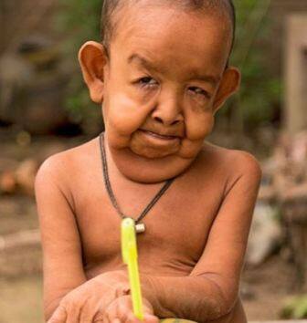 या रुग्णालयातील तज्ज्ञ डॉक्टर त्याला एक सर्वसामान्य मुल बनवतील अशी आमची आशा असल्याचेही लाब्लू यांनी सांगितले.