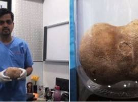 Vasai Kidney Stone Operation 1 किलोचा मूतखडा, यशस्वी शस्त्रक्रिया, लिम्का बुकात नोंद?