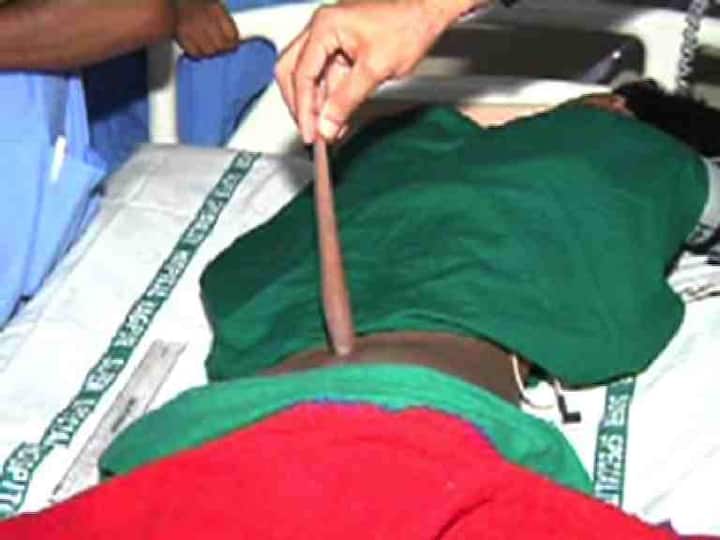 नागपूरः नागपूरच्या रुग्णालयात चक्क शेपटी असलेला रुग्ण दाखल झाला आहे. हॉस्पिटलच्या डॉक्टरांसमोरही यामुळे मोठा प्रसंग उभा राहिला आहे.