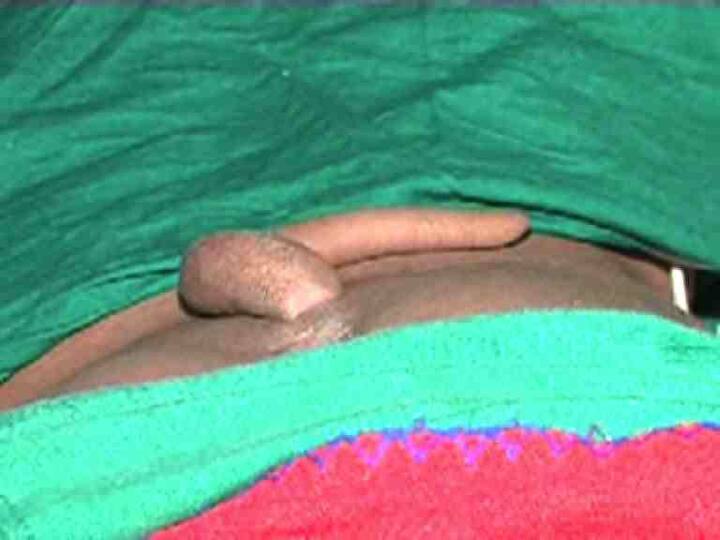 जन्मजात शेपटी असलेला हा तरुण गेली 18 वर्षे हा अवयव आपल्या शरिरावर बाळगतोय. पण जेव्हा तो त्रास असह्य झाला तेव्हा ती काढून टाकण्याचा निर्णय घेतला. 