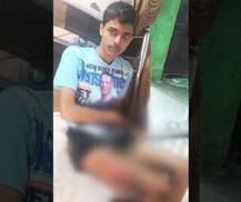 पँटच्या खिशात मोबाईल फोनचा स्फोट, तरुणाचा पाय भाजला