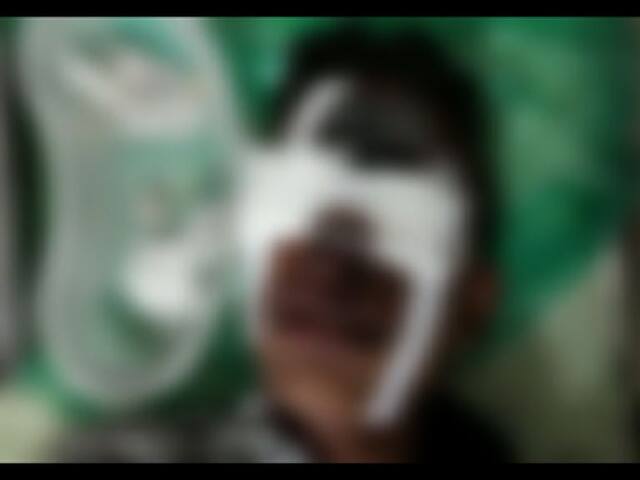 सुतळी बॉम्ब डोळ्याजवळ फुटला, मुलगा गंभीर जखमी