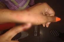 वीज बिलावरुन राडा, तक्रारदार महिलेचा महावितरणच्या अभियंत्याच्या बोटाचा चावा