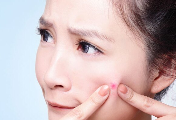 Get rid of acne and blemish at Home with Home Remedies ਚਿਹਰੇ 'ਤੇ ਦਾਣੇ ਤੇ ਮੁਹਾਂਸੇ ਖੂਬਸੂਰਤੀ ਦੇ ਦੁਸ਼ਮਣ, ਘਰੇਲੂ ਨੁਸਖਿਆਂ ਨਾਲ ਕਰੋ ਸਫਾਇਆ