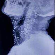 शरीरात 200 हून जास्त टाचण्या, मुंबईतील रुग्णावर उपचाराचं आव्हान