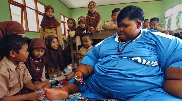 10 Year Old Indonesian Boy Weighs 190 Kg Due To Junk Food Addiction Latest News 190 किलो वजनाच्या दहा वर्षीय चिमुरड्या आर्यवर शस्त्रक्रिया