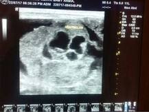 ठाण्यात 4 दिवसांच्या अर्भकाच्या पोटात अविकसित गर्भ