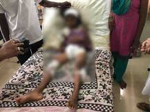 अर्नाळा समुद्रकिनारी 15-20 कुत्र्यांचा चिमुकलीवर हल्ला