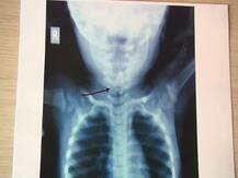 11 महिन्यांच्या चिमुकलीच्या अन्ननलिकेत सेफ्टी पिन अडकली!