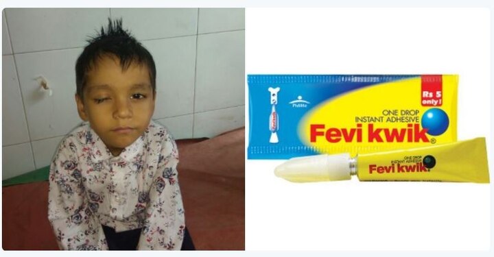 Jalgaon boy drops feviquick in eyes खेळता खेळता फेवीक्विक डोळ्यात टाकलं, पापण्यांचे केस कापून डोळा उघडला