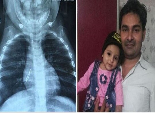 7 months old baby girl swallowed LED Bulb latest update सात महिन्यांच्या चिमुरडीने गिळला एलईडी बल्ब