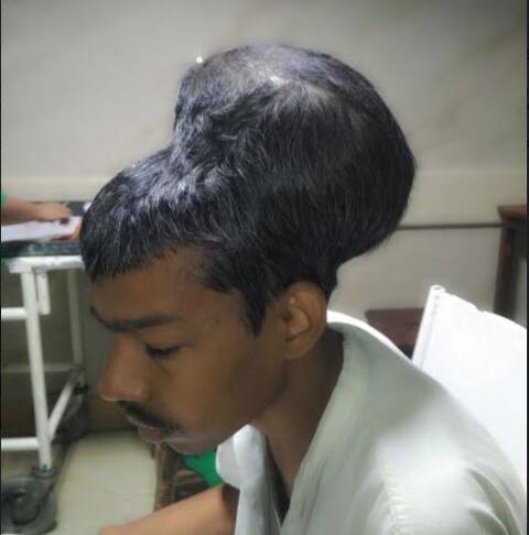 नायर रुग्णालयात जगातील सर्वात मोठ्या ब्रेन ट्यूमरची शस्त्रक्रिया नायर रुग्णालयात जगातील सर्वात मोठ्या ब्रेन ट्यूमरची शस्त्रक्रिया