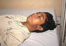 मुलाच्या नाकात अडकलेली काडी तब्बल सहा वर्षांनी काढली