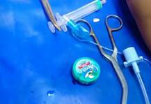 सहा महिन्याच्या बाळाने विक्सची डबी गिळली, शर्थीचे प्रयत्न करुन डॉक्टरांनी गळ्यात अडकलेली डबी काढली