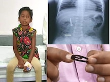 तोंडात धरलेली केसांची पिन अनवधानाने पोटात, चार महिन्यांनी चिमुरडीची असह्य वेदनांमधून सुटका