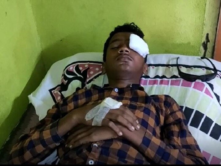 Boy lost his eye after mobile blast in kolhapur गेम खेळताना मोबाईलचा स्फोट, मुलाचा डोळा निकामी