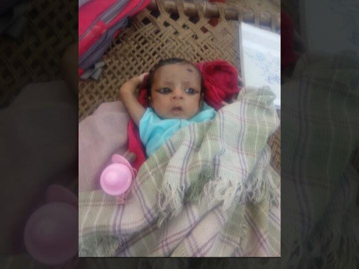 KEM hospital firecase : two month old baby passes away केईएम रूग्णालयाच्या निष्काळजीपणामुळे हात गमावलेल्या चिमुकल्याच्या दुर्दैवी मृत्यू
