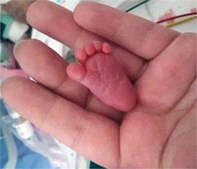 ਰਿਪੋਰਟਾਂ ਦੀ ਮੰਨੀਏ ਤਾਂ ਇੰਨੇ ਘੱਟ ਭਾਰ ਦੇ ਬਾਵਜੂਦ ਜ਼ਿੰਦਾ ਬਚਣ ਵਾਲੀ ਐਮੀਲੀਆ ਪਹਿਲੀ ਬੱਚੀ ਬਣ ਗਈ ਹੈ। ਇਸ ਤੋਂ ਪਹਿਲਾਂ ਇਹ ਰਿਕਾਰਡ ਸ਼ਿਕਾਗੋ ਦੀ ਰਹਿਣ ਵਾਲੀ ਇੱਕ ਕੁੜੀ ਦੇ ਨਾਂ 'ਤੇ ਸੀ, ਜਿਸ ਦਾ ਭਾਰ 243 ਗਰਾਮ ਸੀ। ਡਾਕਟਰਾਂ ਦਾ ਕਹਿਣਾ ਹੈ ਕਿ ਜਨਮ ਦੇ ਸਮੇਂ ਜਿਨ੍ਹਾਂ ਬੱਚਿਆਂ ਦਾ ਭਾਰ 400 ਗਰਾਮ ਤੱਕ ਹੁੰਦਾ ਹੈ, ਉਹ ਵੀ ਬੇਹੱਦ ਮੁਸ਼ਕਿਲ ਨਾਲ ਬਚ ਪਾਉਂਦੇ ਹਨ। ਅਜਿਹੇ ਵਿਚ ਐਮੀਲੀਆ ਦਾ ਬਚ ਜਾਣਾ ਕਿਸੇ ਚਮਤਕਾਰ ਤੋਂ ਘੱਟ ਨਹੀਂ ਹੈ।