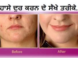 Acne Face ਮੁਹਾਸੇ ਦੂਰ ਕਰਨ ਦੇ ਸੌਖੇ ਤਰੀਕੇ