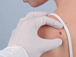 Control Mole: ਇੰਨਾਂ ਨੁਸਖਿਆਂ ਨਾਲ ਘਰ 'ਚ ਹੀ ਖ਼ਤਮ ਕਰੋ ਮੋਕਿਆਂ ਨੂੰ