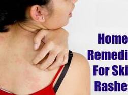 ਲਾਲ ਰੰਗ ਦੇ ਧੱਫੜ ਤੋਂ ਬਚਾਅ ਦੇ ਘਰੇਲੂ ਓਪਾਅ ਜਾਣੋ