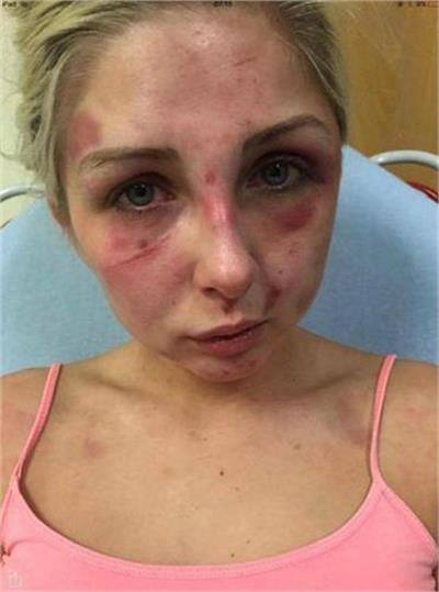 ਸਕਾਟਲੈਂਡ: ਪ੍ਰੇਮੀ-ਪ੍ਰੇਮਿਕਾ ਵਿਚਕਾਰ ਲੜਾਈ-ਝਗੜਾ ਤਾਂ ਹੁੰਦਾ ਰਹਿੰਦਾ ਹੈ ਪਰ ਸਕਾਟਲੈਂਡ ਦੇ ਡੰਬਾਰਟਨ ਸ਼ਹਿਰ 'ਚ ਇਕ ਹੈਰਾਨ ਕਰਨ ਵਾਲਾ ਮਾਮਲਾ ਸਾਹਮਣਾ ਆਇਆ ਹੈ। ਇੱਥੇ ਪੇਸ਼ੇ ਤੋਂ ਮੇਕਅੱਪ ਕਲਾਕਾਰ ਨੂੰ ਉਸਦੇ ਪ੍ਰੇਮੀ ਨੇ ਸਿਗਰਟ ਦਾ ਪੈਕਟ ਗੁਆਉਣ ਦੀ ਗੱਲ 'ਤੇ ਇੰਨਾ ਕੁੱਟਿਆ ਕਿ ਉਹ ਬੇਹੋਸ਼ ਹੋ ਗਈ ਅਤੇ 4 ਦਿਨਾਂ ਤੋਂ ਹਸਪਤਾਲ 'ਚ ਭਰਤੀ ਹੈ। 